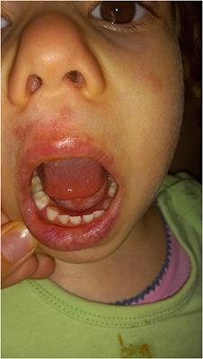 Case Report: Early Onset Systemic Lupus Erythematosus Due to Hereditary C1q Deficiency Treated With Fresh Frozen Plasma